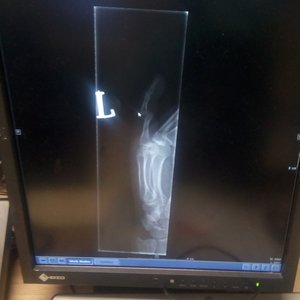 Dislocated pinky